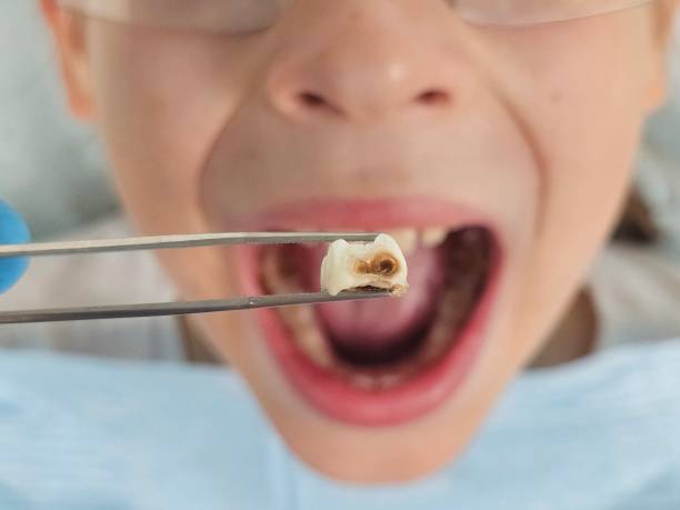 Best Chipped Tooth Repair Near Me  in Keowee Key, SC